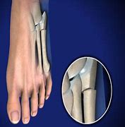 Image result for Jones Fracture