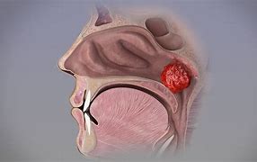 Image result for adenoidal