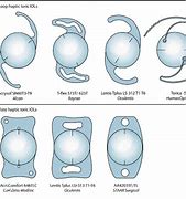 Image result for Toric Lenses Cataract Surgery