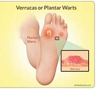 Image result for Pictures of Plantar Warts