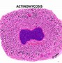 Image result for actinomicosid