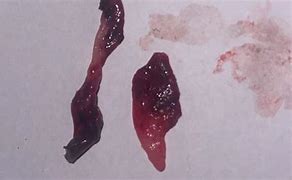 Image result for What Does a Miscarriage Blood Look Like