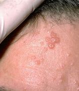 Image result for Musculum Warts