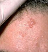 Image result for Molluscum Contagiosum Atopic Dermatitis