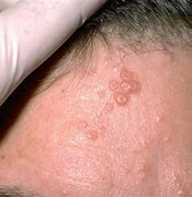 Image result for Infectious Molluscum