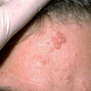 Image result for Popping Molluscum
