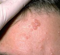 Image result for Molluscum Treatment with Laser