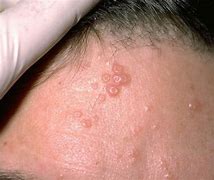 Image result for Molluscum Contagiosum Scabbed Over