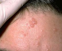 Image result for Pimples Caused by Molluscum