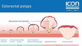 Image result for 1 mm Polyp in Colon