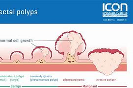 Image result for Colon Polyps Cancer Symptoms