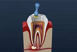 Image result for Unicore Drill Endodontics
