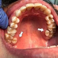 Image result for Unusual Wisdom Teeth