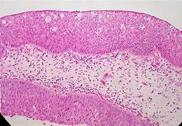 Image result for Papilloma Nose
