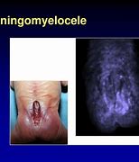 Image result for Meningomyelocele vs Myelomeningocele