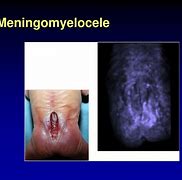 Image result for Meningomyelocele vs Meningocele