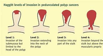Image result for Cancerous Polyps