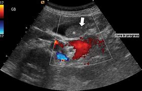Image result for Gallbladder Sludge Ultrasound