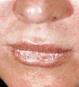 Image result for Actinic Keratosis Lip