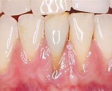 Image result for Gingival Recession