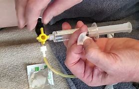 Image result for Biliary Drainage Catheter Placement