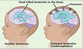 Image result for Hydrocephalus Baby Development