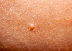 Image result for Molluscum in the Groin