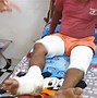 Image result for Injuries From Exploding Phones