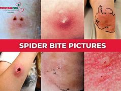 Image result for Bad Spider Bites Pictures