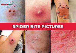Image result for Non Venomous Spider Bite
