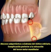Image result for dent�culo