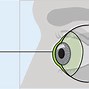 Image result for Ocular Surface Disorders and Scleral Lens