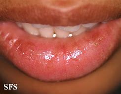 Image result for Allergic Reaction Swollen Upper Lip