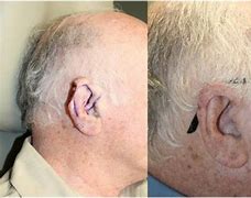 Image result for Skin Cancer Removed From Helix