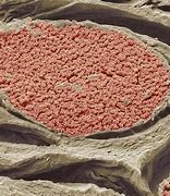 Image result for Molluscum Contagiosum Virus Cell Anatomy