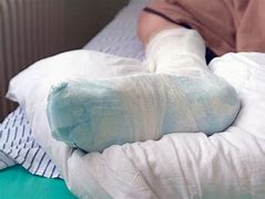 Image result for Broken Leg Cast Bed