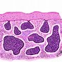 Image result for Basal Cell Carcinoma Pathology