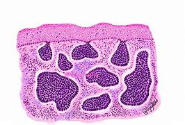 Image result for Basal Cell Carcinoma Pathology