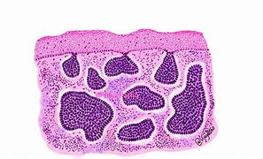 Image result for Invasive Basal Cell Carcinoma