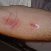 Image result for Blood Rashes On Skin