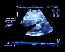 Image result for 5 Week Loss at 9 Weeks Tissue