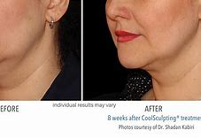 Image result for CoolSculpting Elite Chin
