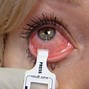 Image result for adenolpg�a