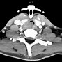Image result for Esophagus CT
