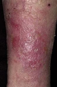 Image result for What Does Skin Dermatitis Look Like
