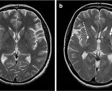 Image result for Parkinson's Disease Brain MRI