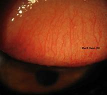 Image result for Conjunctival Papilloma