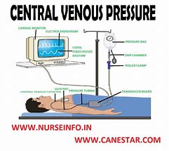 Image result for Centrel Venous Pressure
