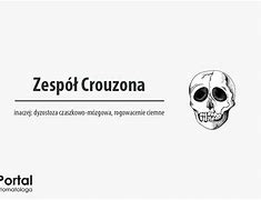 Image result for co_to_za_zespół_crouzona