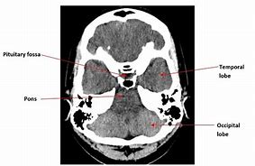 Image result for Pituitary Anatomy MRI